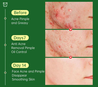 Herbal Acne Cream - Natural Acne Spot Treatment and Moisturizer for Clear Skin