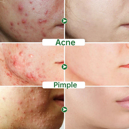 Herbal Acne Cream - Natural Acne Spot Treatment and Moisturizer for Clear Skin